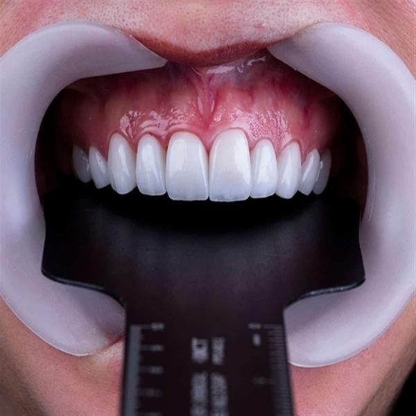 ابزار دنتال فتوگرافی